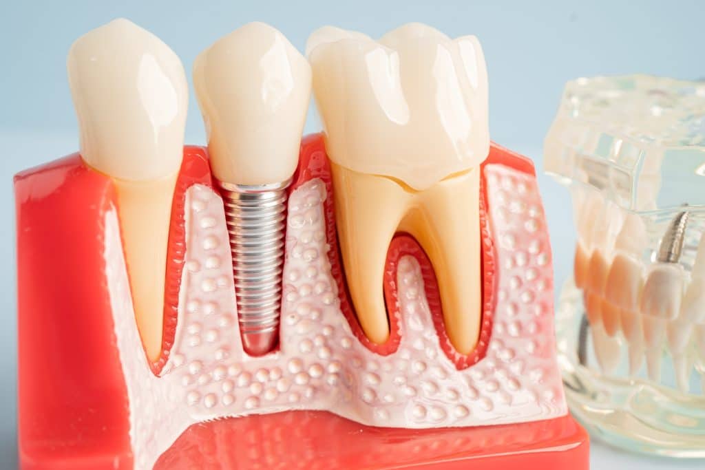 Colocación de implantes dentales en Clínica Dental Santa Mónica